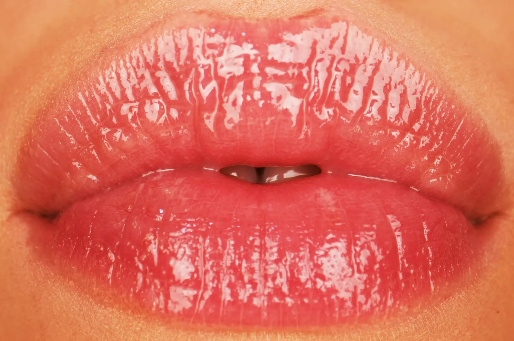 Lip Fillers