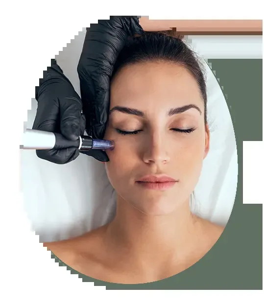Microneedling at Desert Rain Skin